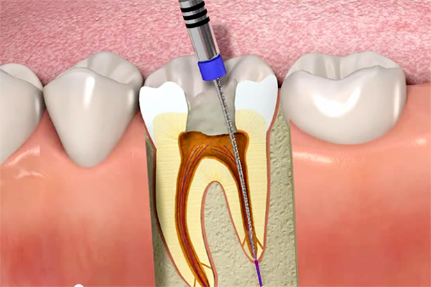 https://www.smilepartners.it/wp-content/uploads/2024/10/icon-endodonzia.png